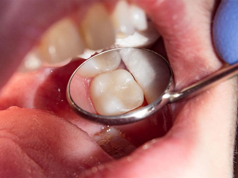 Teeth Whitening in Quincy, MA Dental Associates Inc